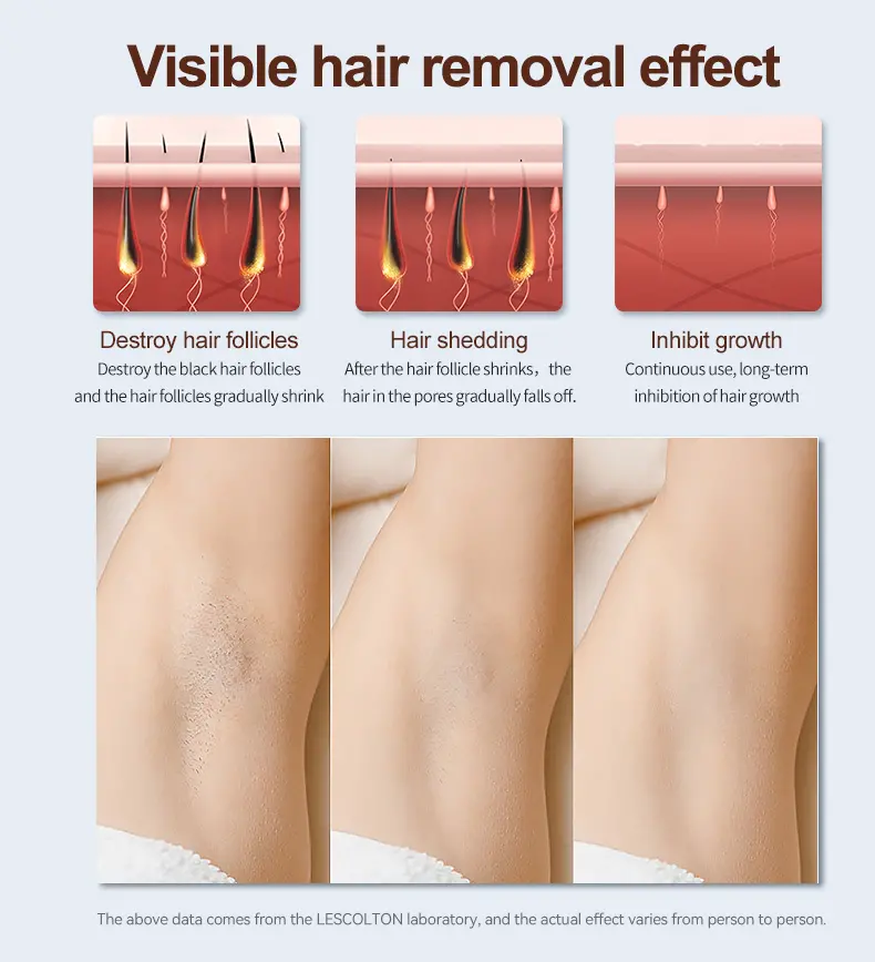 hair removal for women