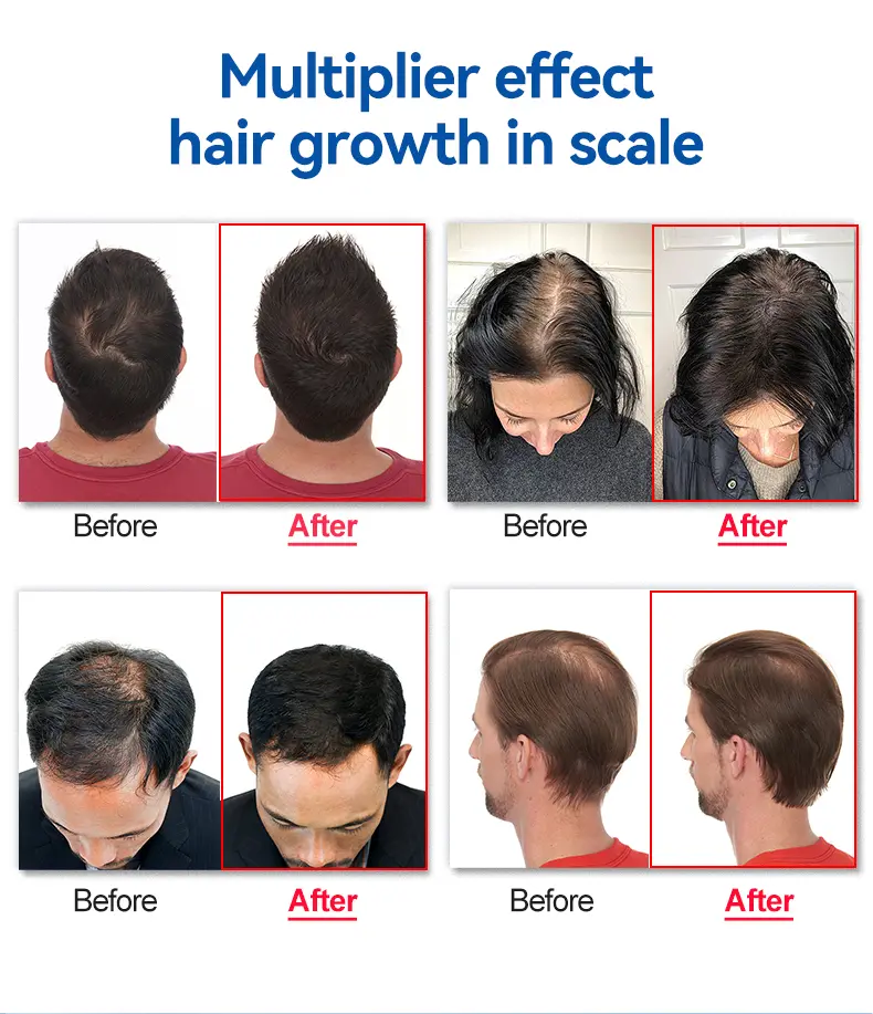 laser cap for hair loss