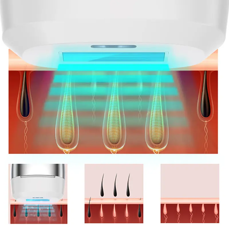 laser hair removal