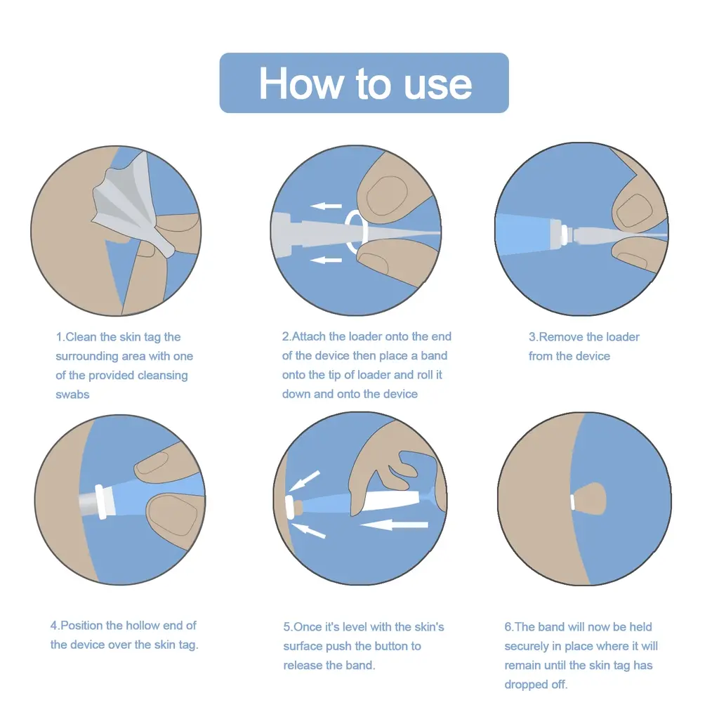 skin tag removal kit
