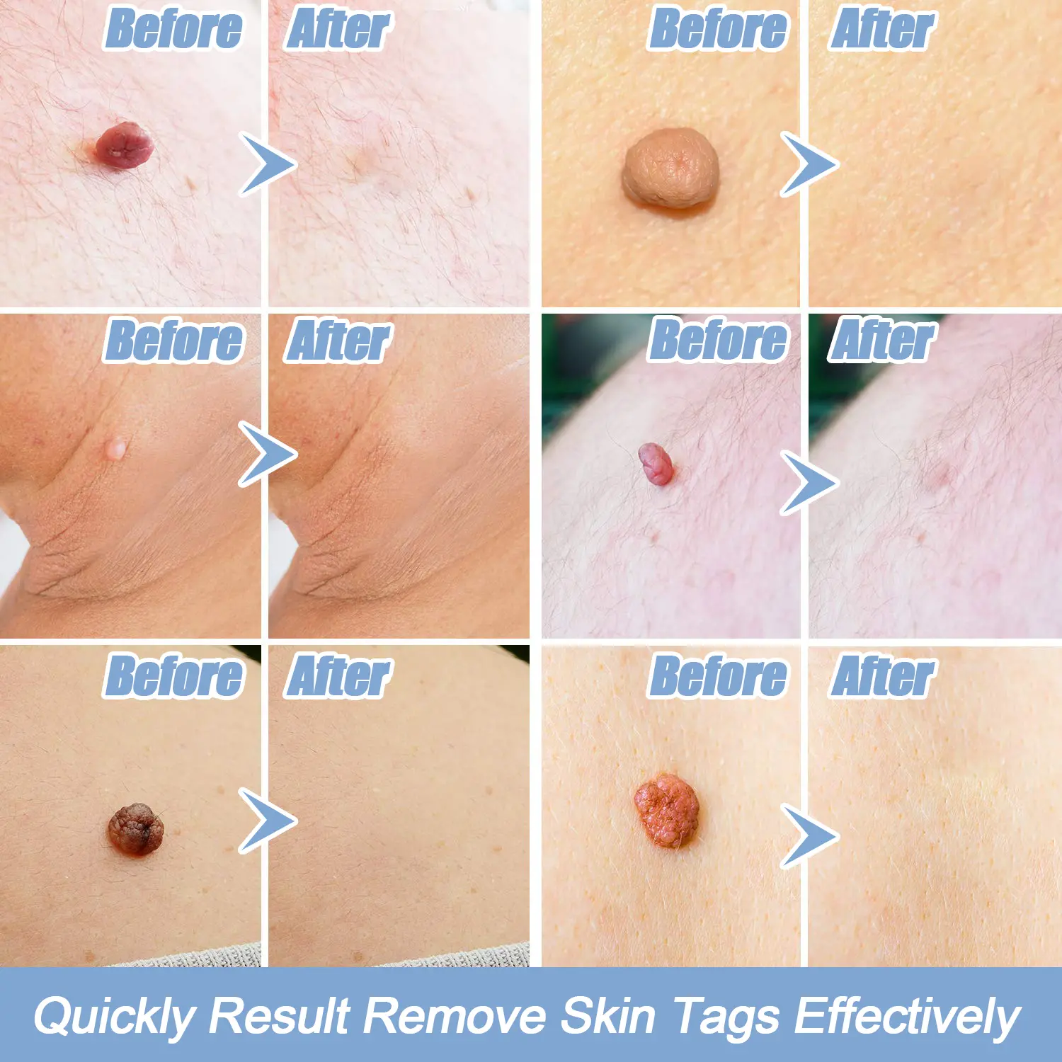 skin tag removal kit