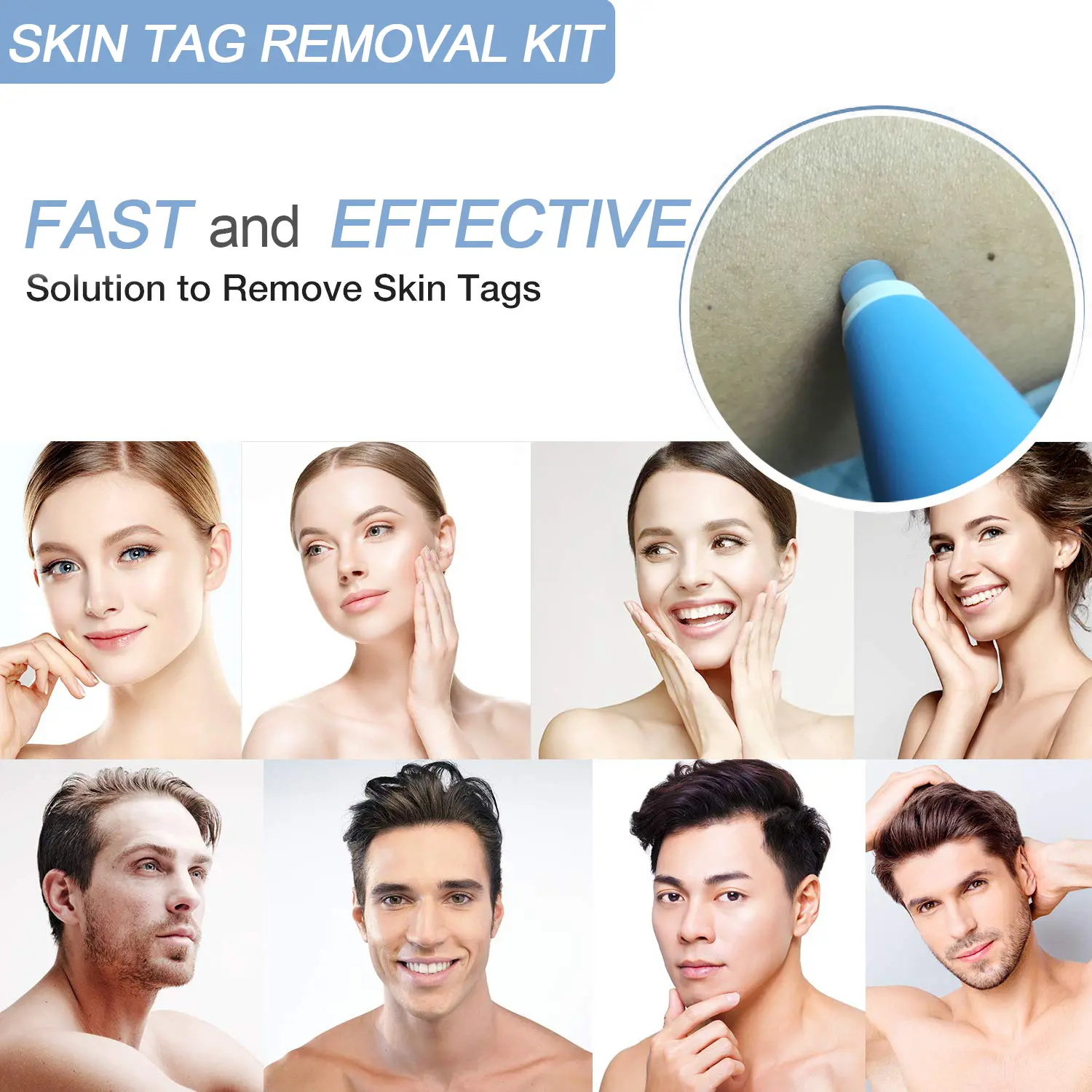 skin tag removal kit