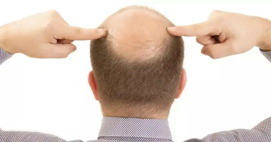 What should we do about hair loss 
