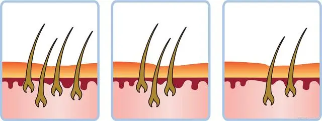 alopecia regrowth stages
