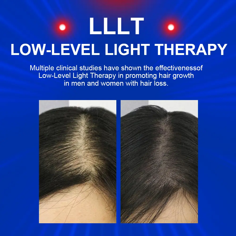 androgenetic alopecia