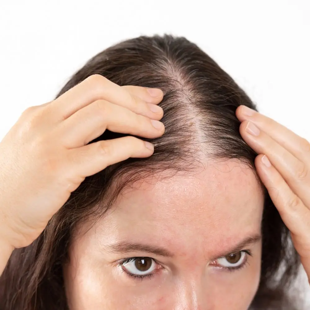 hair loss 