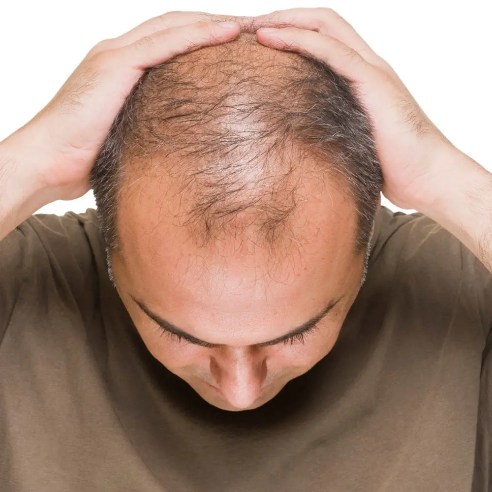 Understanding Hair Loss: Causes and Solutions
